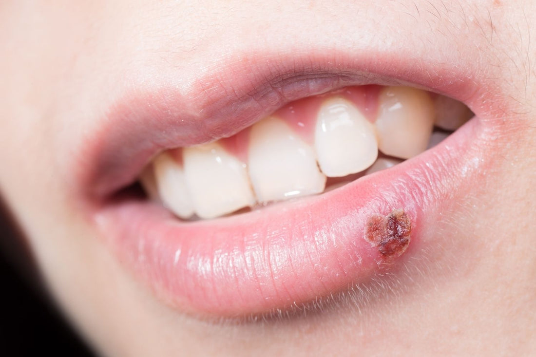 Cold Sore Patches and Bandages: How They Work