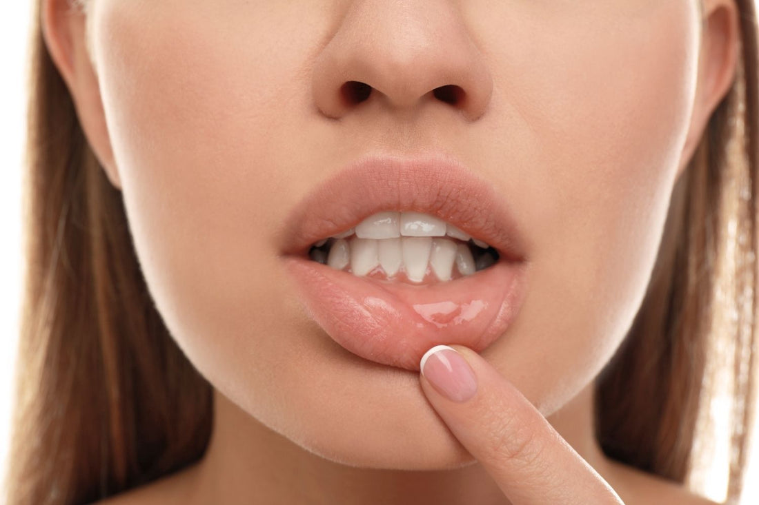Cold Sore Stages: Day by Day, with Photos
